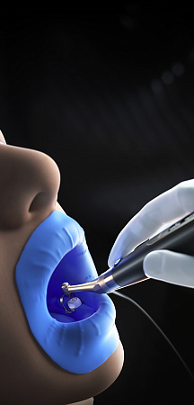 Woodpecker Ai Motor — Эндомотор