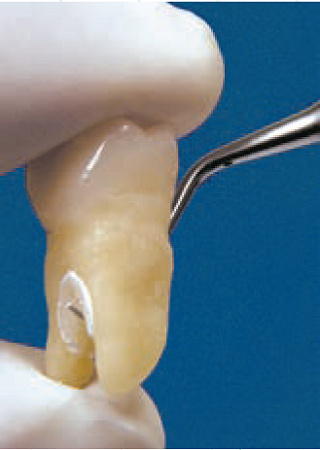 Acteon насадка H2R – премоляры и моляры, правосторонняя, с алмазным покрытием, (неглубокий пародонт)