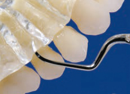 Acteon насадка H4R – Насадка премоляры и моляры, правосторонняя, (неглубокий пародонт)