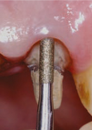 Acteon PMS2 – Насадка для скайлера с алмазным покрытием