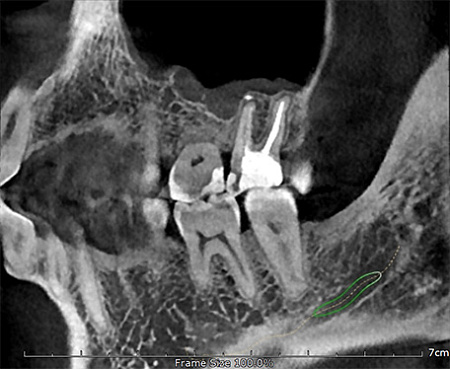 GENORAY Papaya 3D Plus 16x14 - компьютерный томограф с цефалостатом